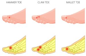 Mallet toe, hammer toe, claw toe