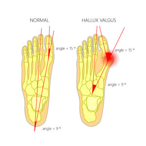 bunion massage, bunion stretches