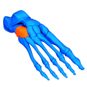 Cuboid Syndrome bone pain fracture