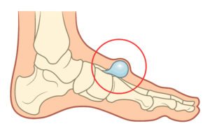 Top of the foot pain and top of the foot bone spur