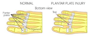 plantar plate tear