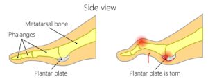 capsulitis 2nd toe