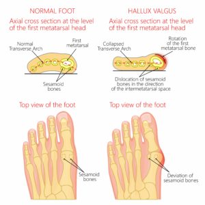 bunion anatomy, bunion causes, bunion pain