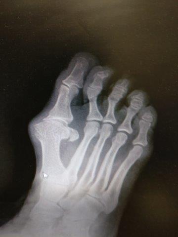 big toe joint arthritis bone spur